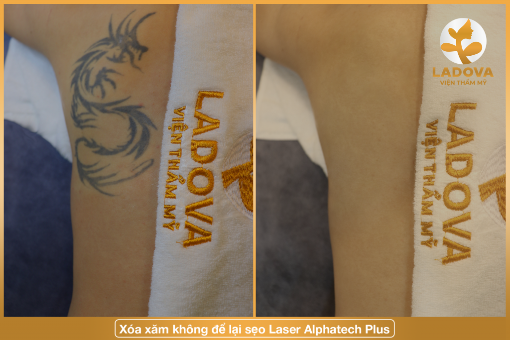 xoa-hinh-xam-o-dau-hcm