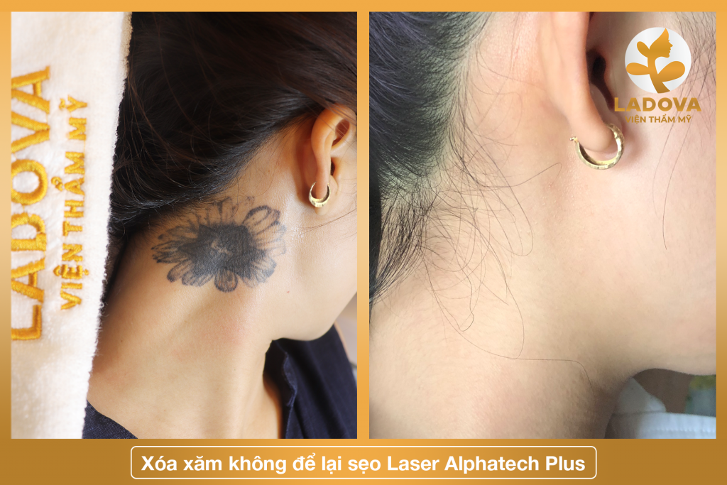 xoa-hinh-xam-o-hcm