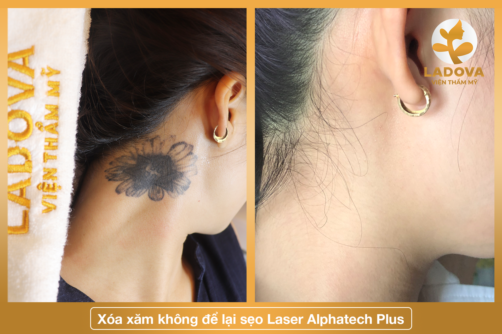 xoa-hinh-xam-o-hcm
