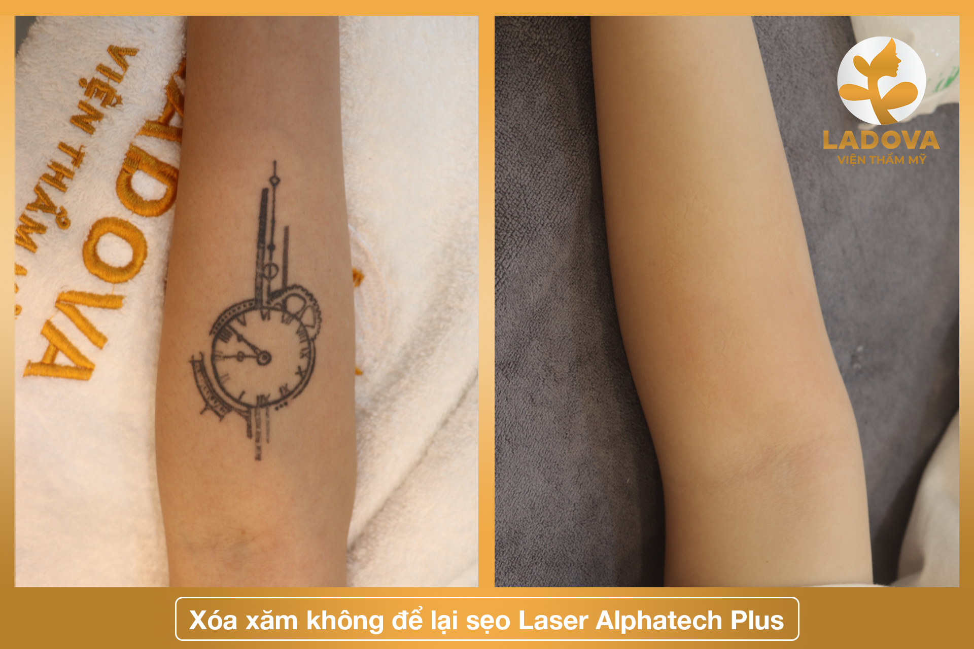 xoa-xam-o-hcm