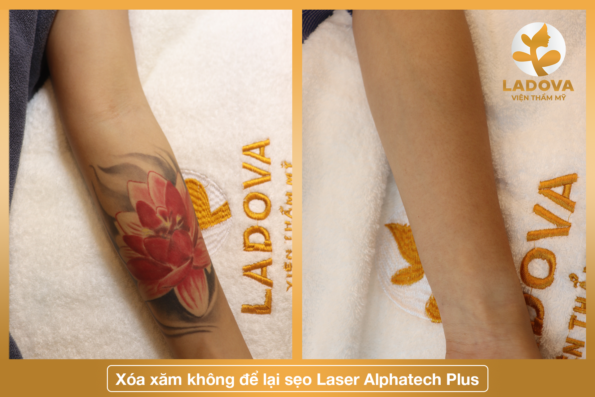 xoa-hinh-xam-gia-re