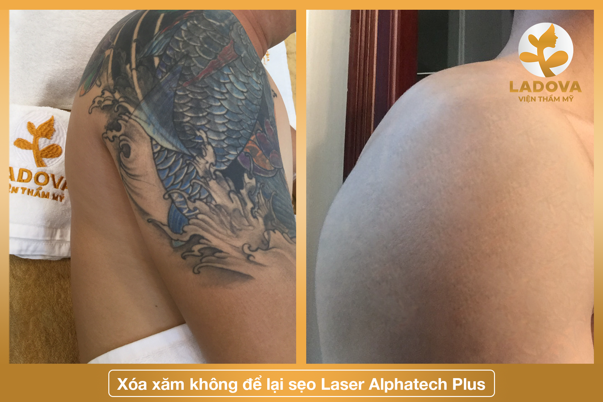 xoa-xam-o-tan-binh
