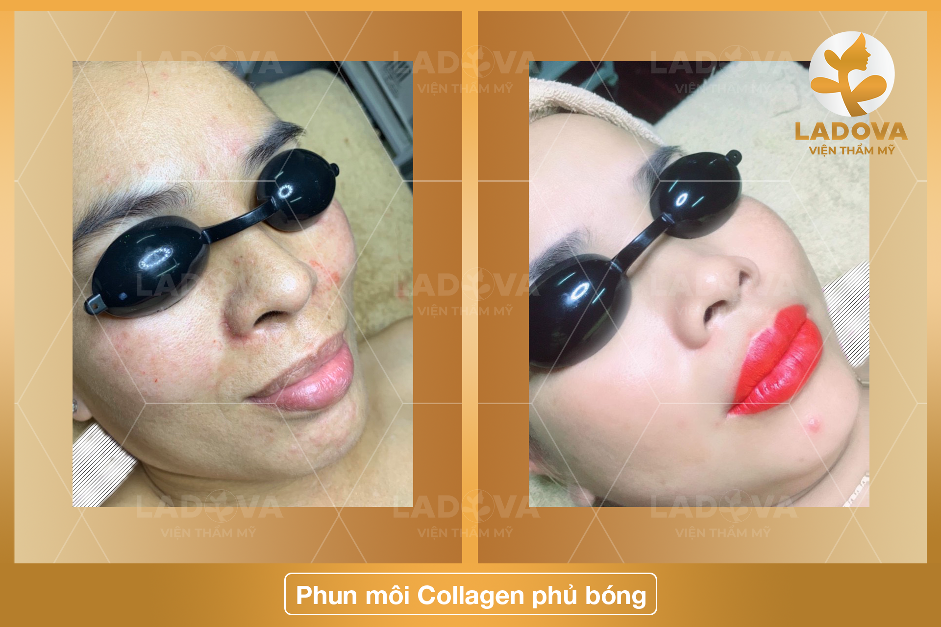 phun-moi-collagen-phu-bong-dep