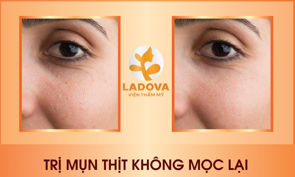 tri-mun-thit-hieu-qua