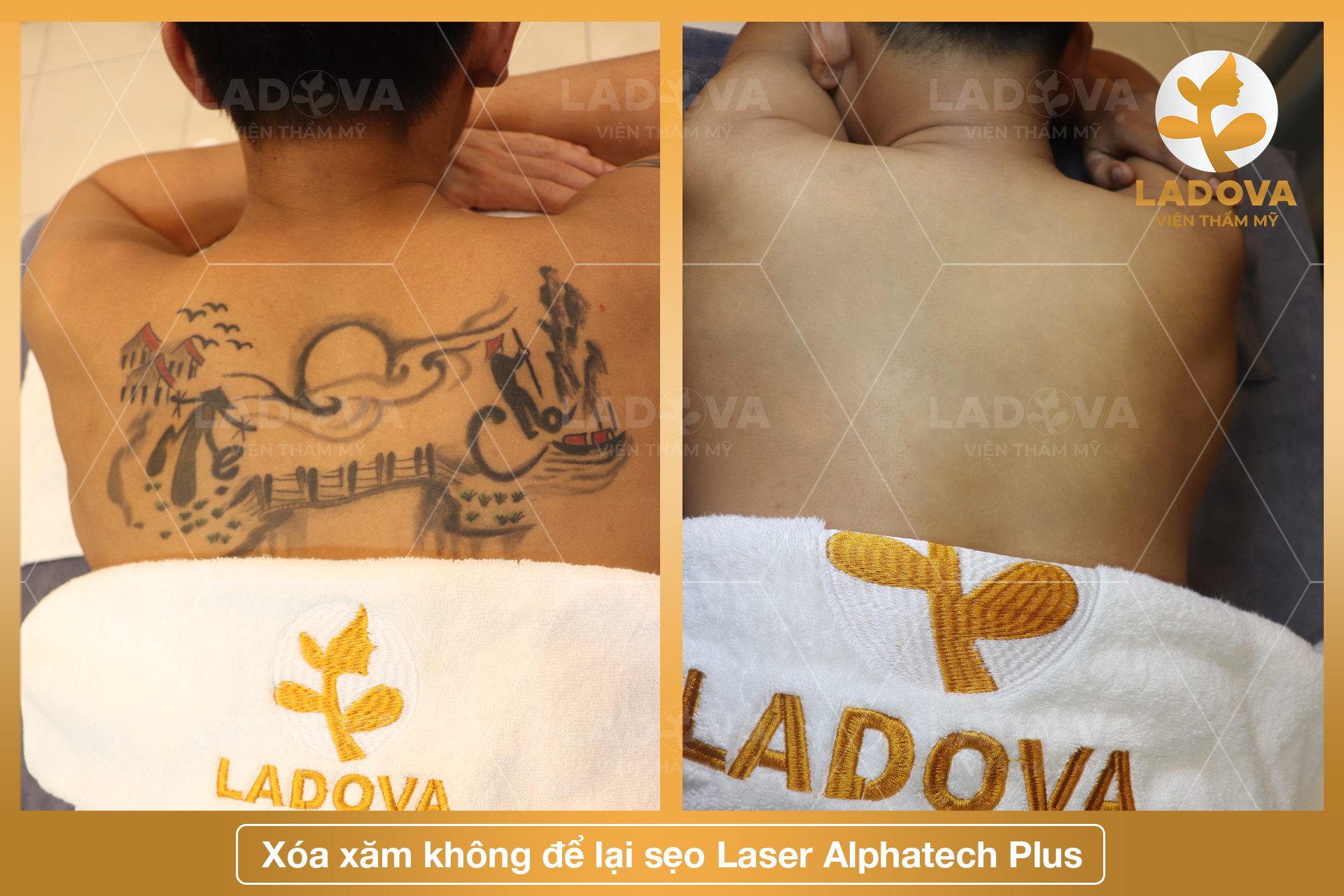 xoa-xam-bao-nhieu-tien