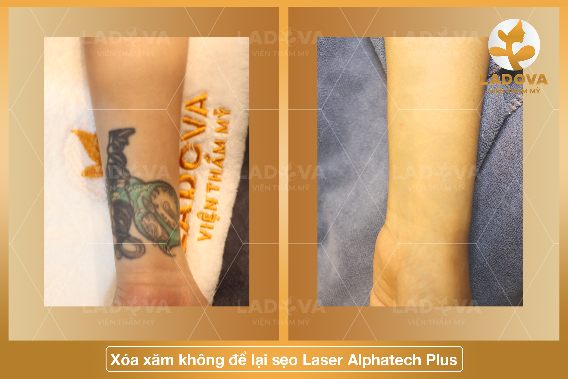 xoa-xam-bao-nhieu-tien