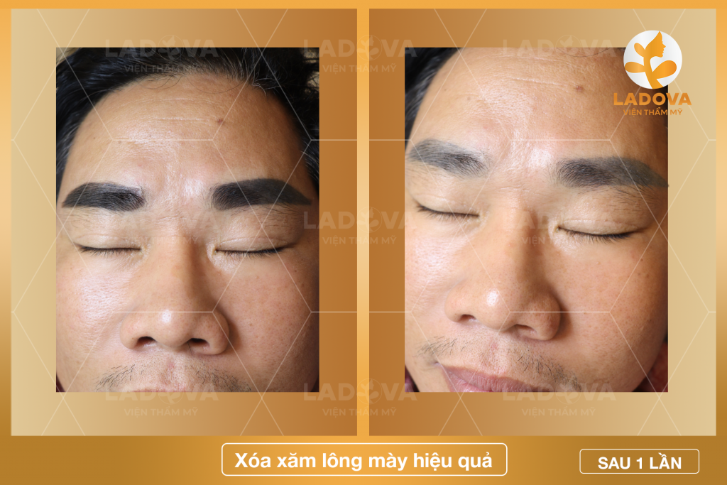 xoa-xam-long-may-tphcm