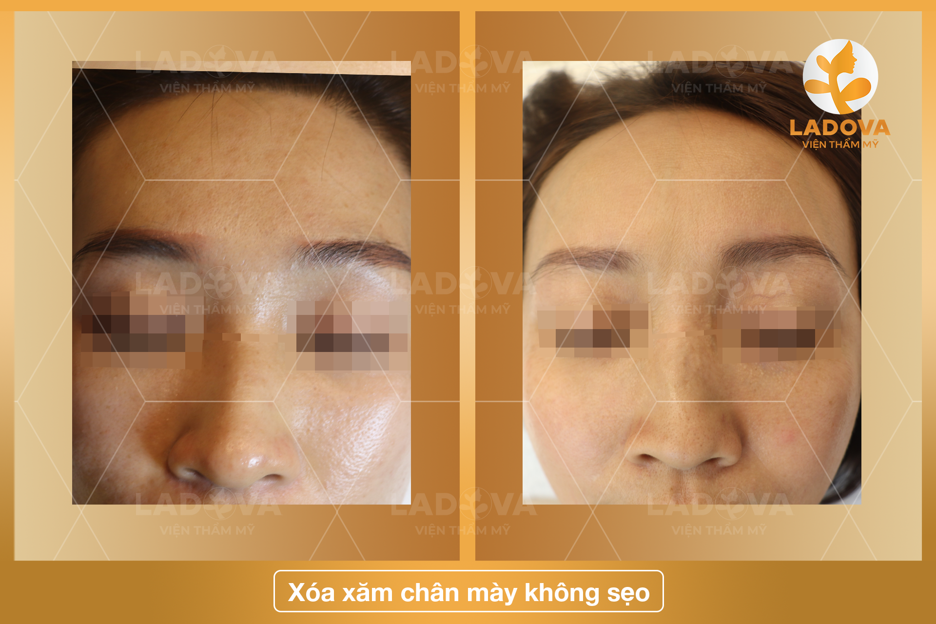 XOA-XAM-CHAN-MAY-BANG-LASER