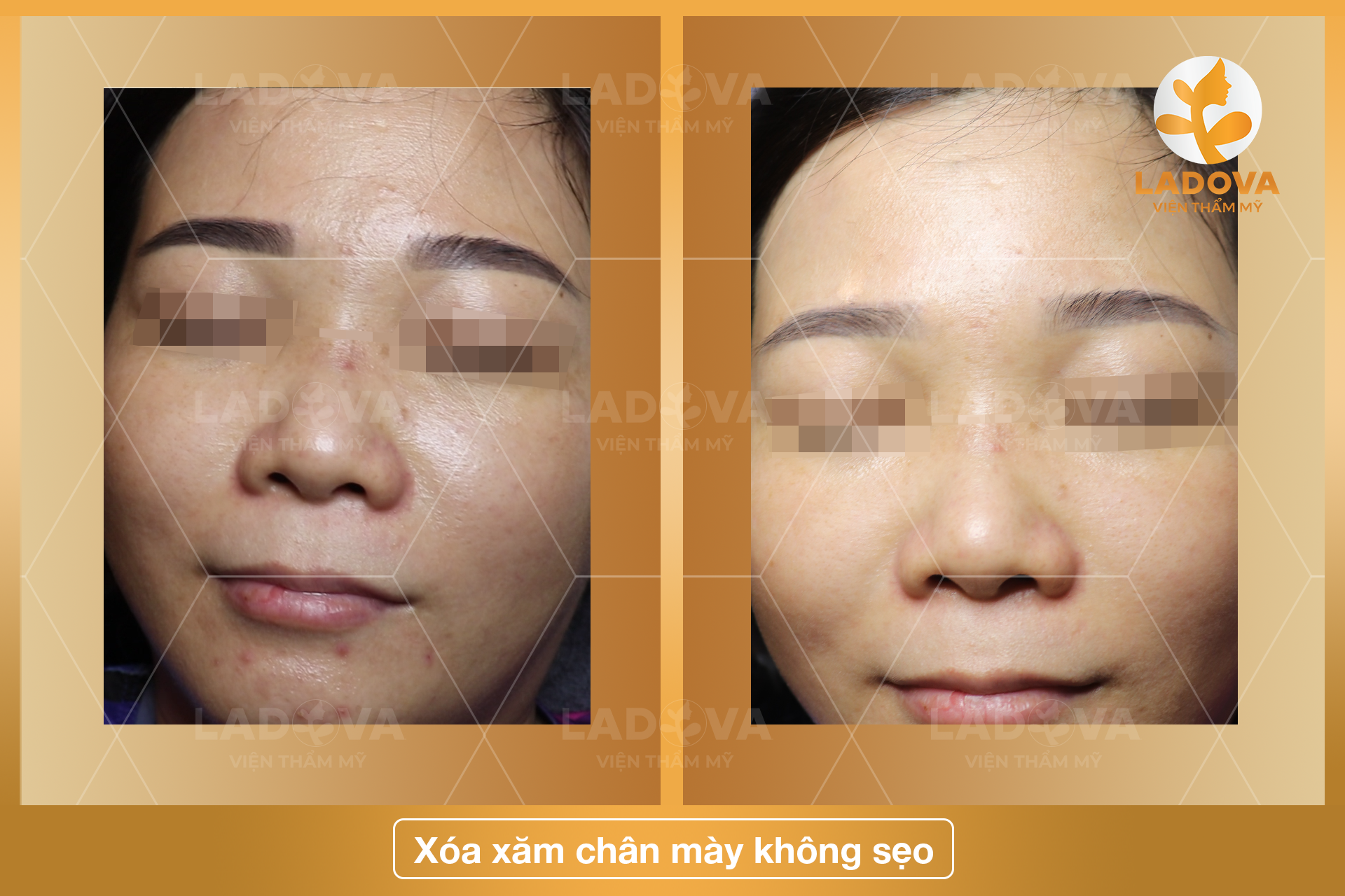XOA-XAM-CHAN-MAY-HIEU-QUA