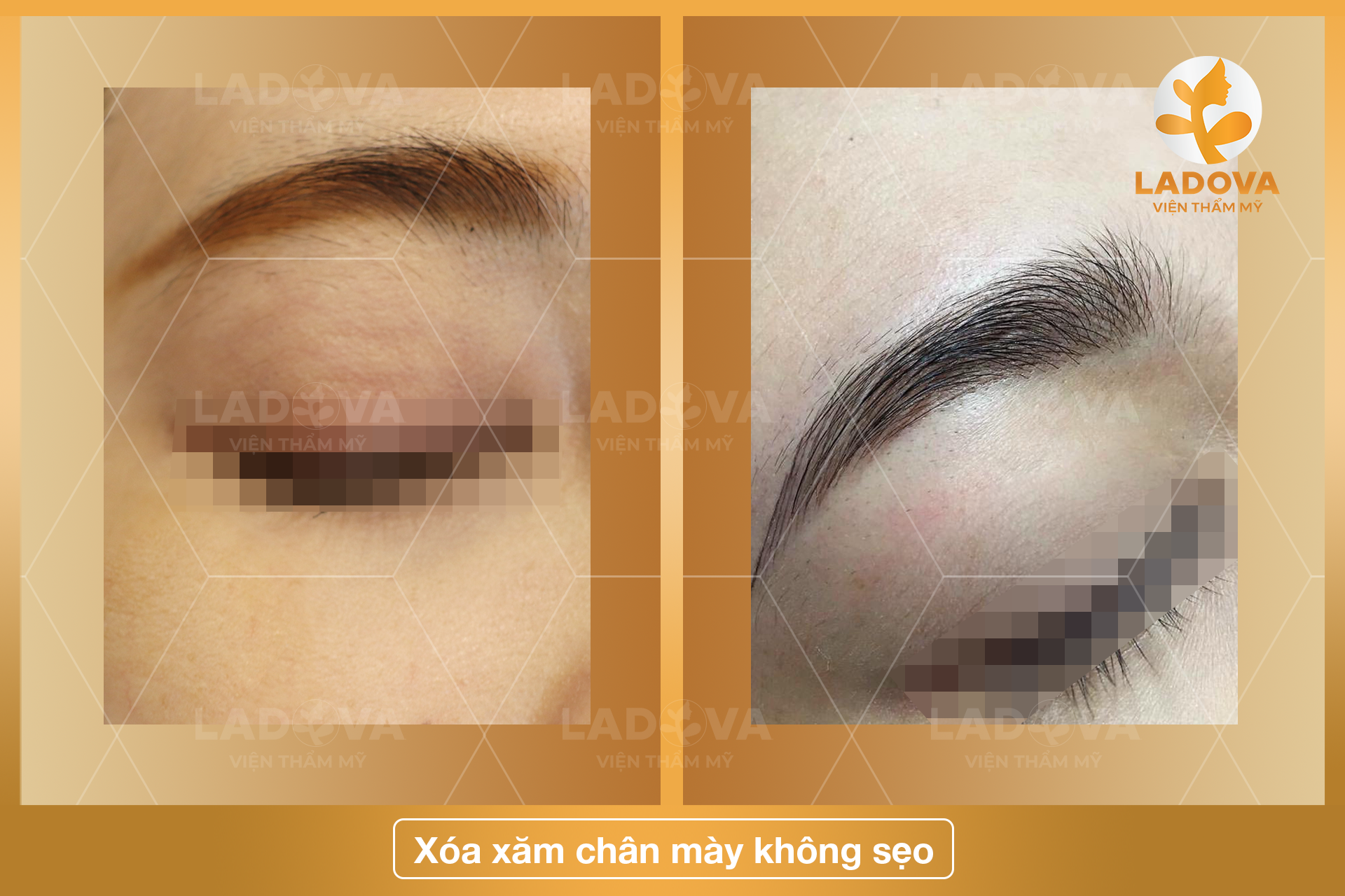 XOA-XAM-LONG-MAY-KHONG-SEO