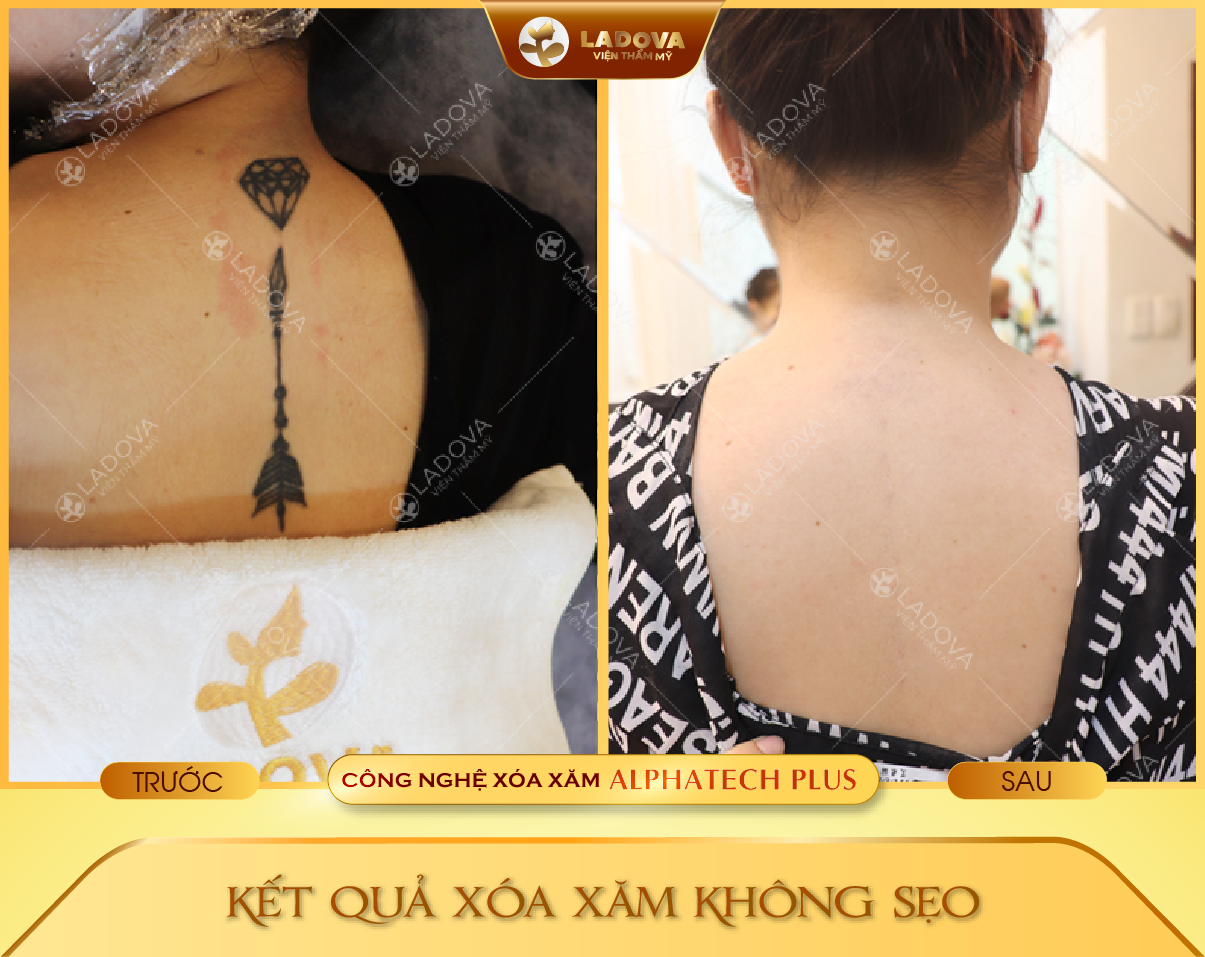 XOA-HINH-XAM-HIEU-QUA-01