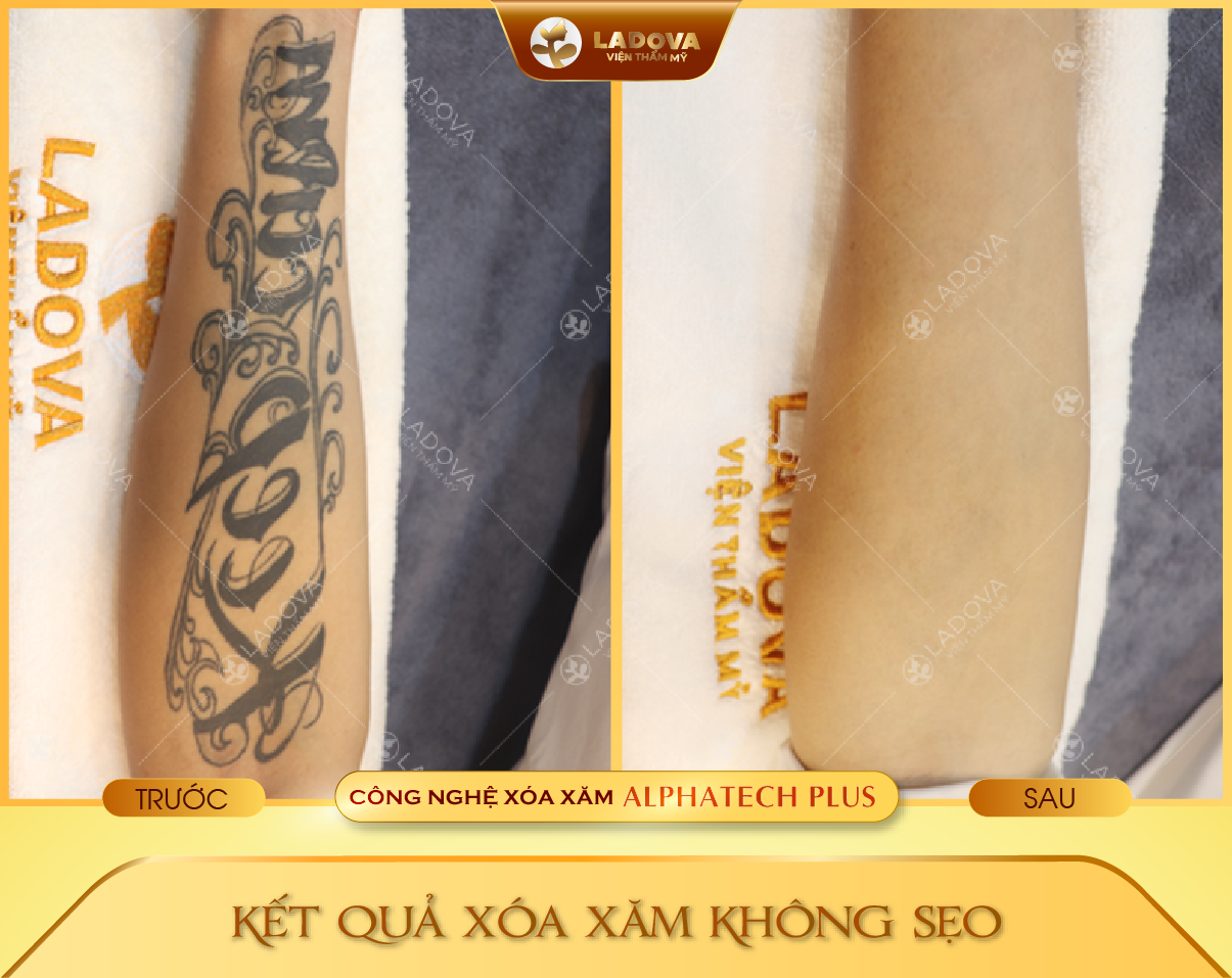 XOA-HINH-XAM-HIEU-QUA-TPHCM-01-01
