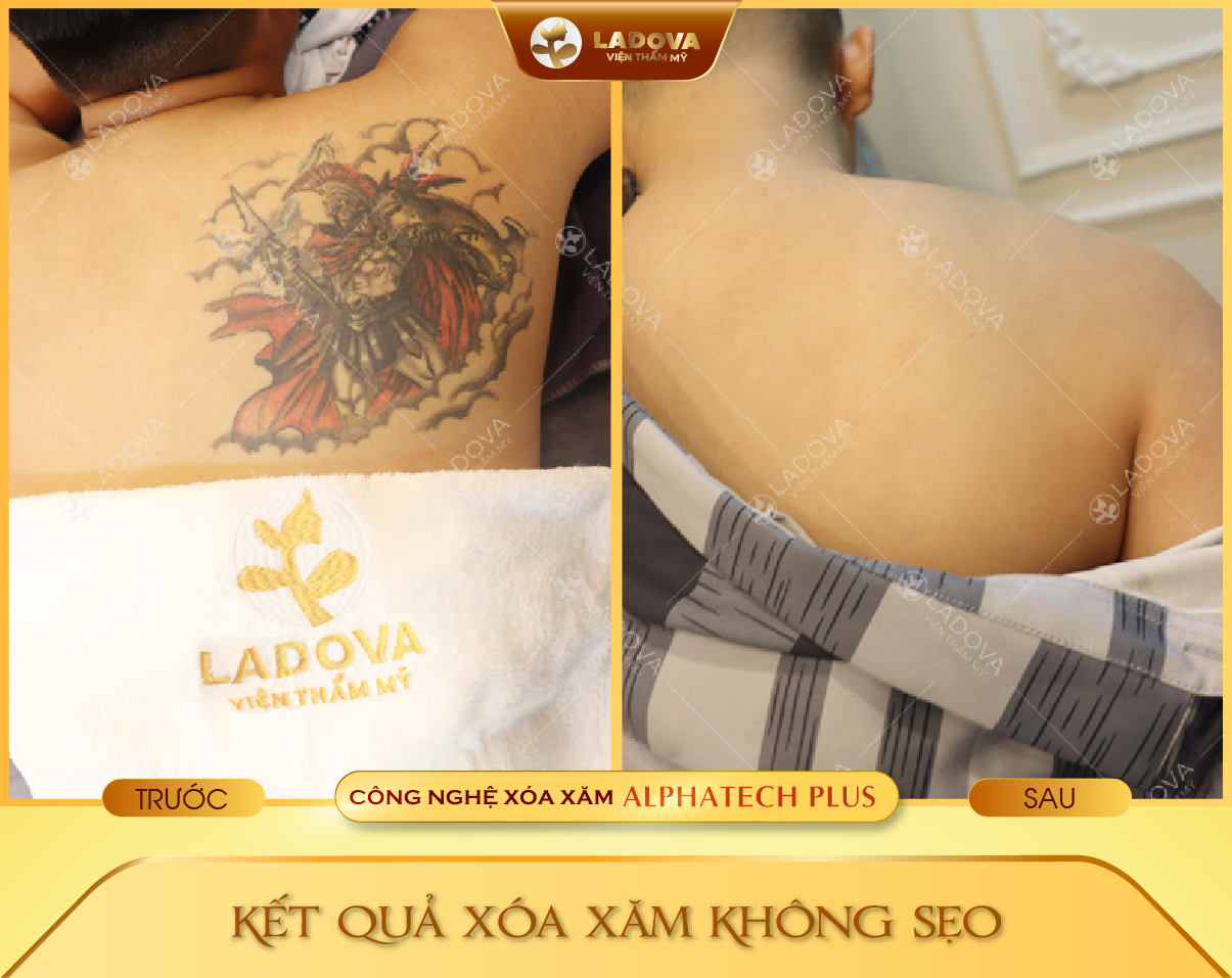 XOA-HINH-XAM-THANH-CONG-01-01
