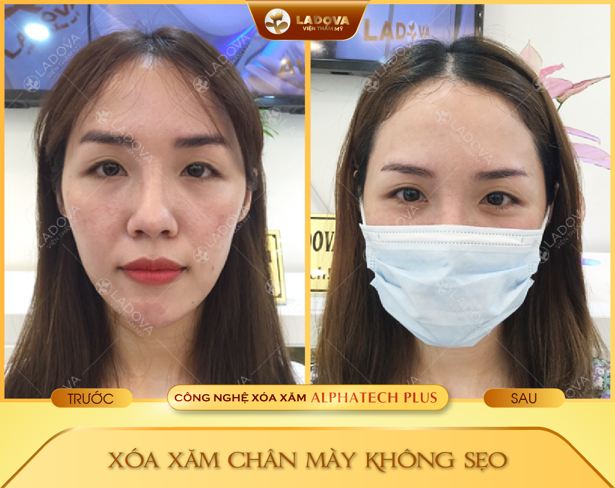 XOA-XAM-CHAN-MAY-HIEU-QUA-01