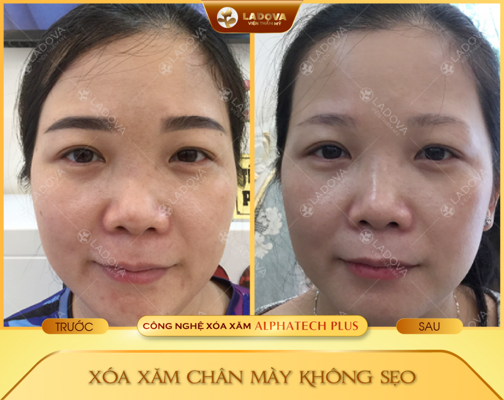 XOA-XAM-LONG-MAY-BANG-LASER-01