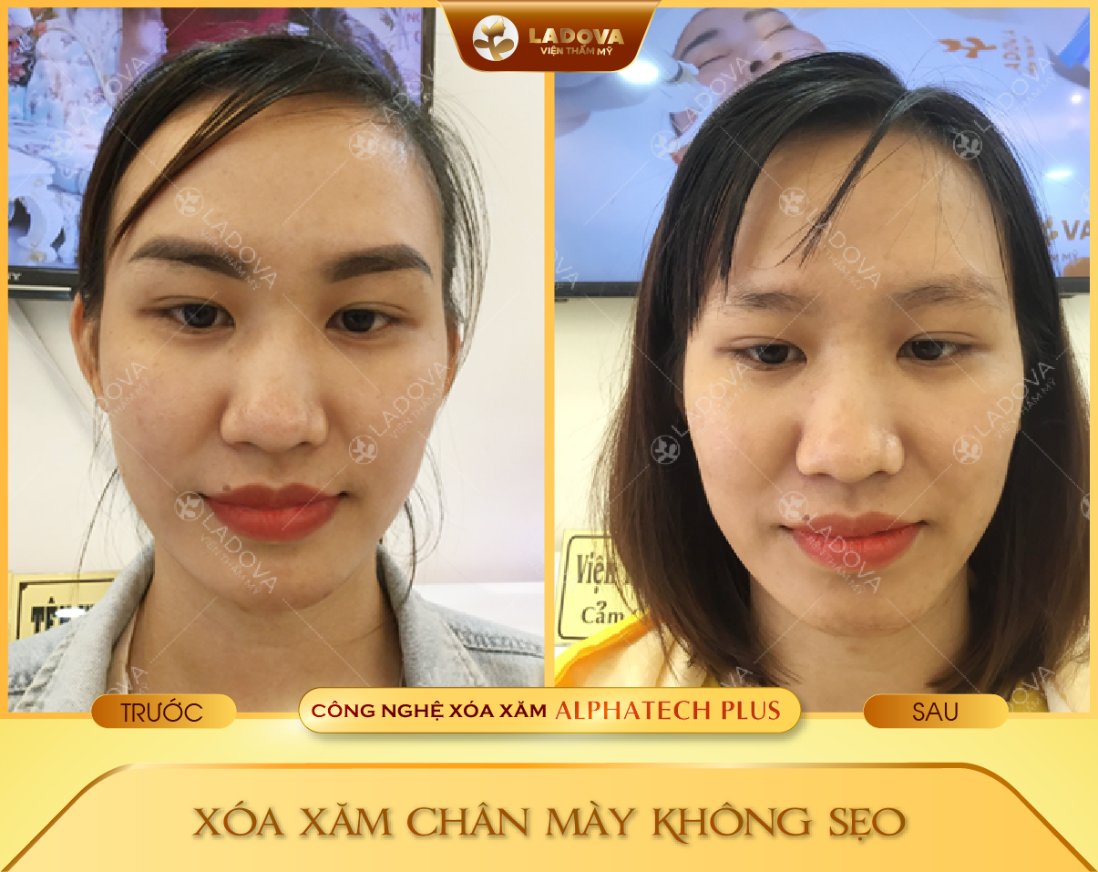 XOA-XAM-LONG-MAY-HIEU-QUA-01