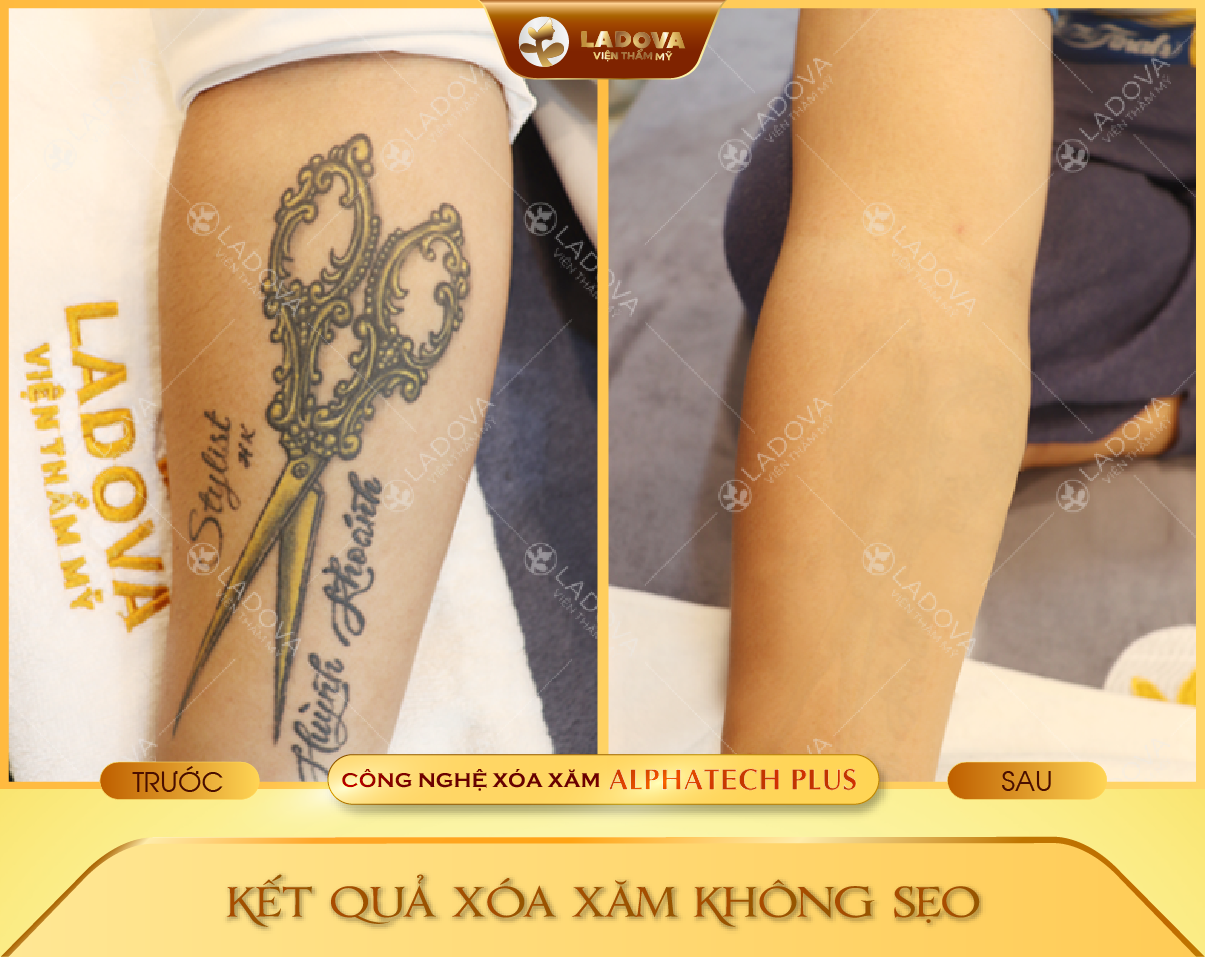 hinh-xam-sau-khi-xoa-01