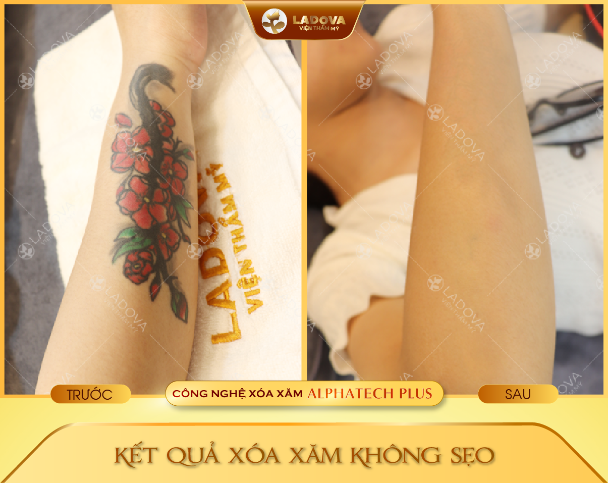 xoa-hinh-xam-mau-01