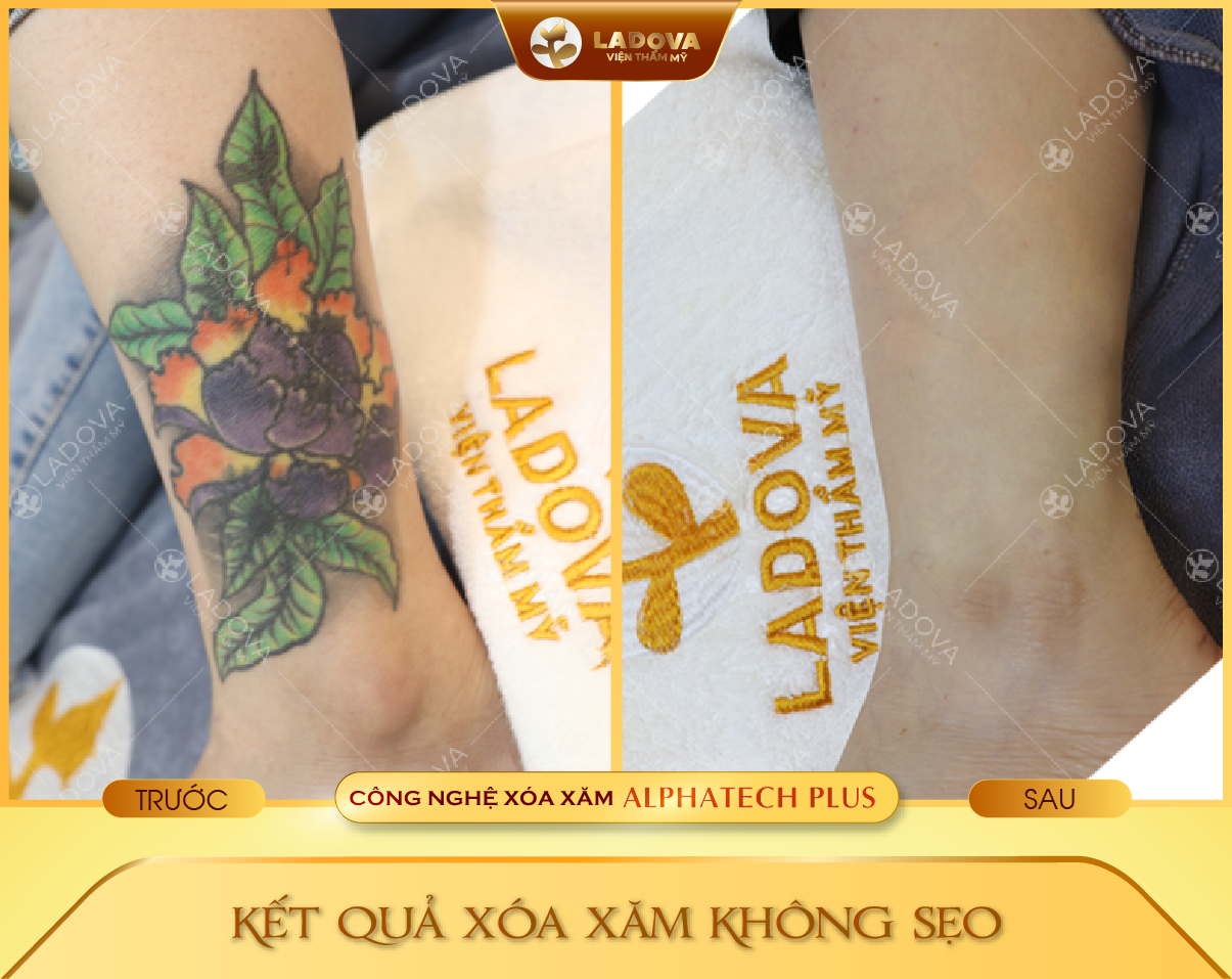 xoa-hinh-xam-o-chan-01
