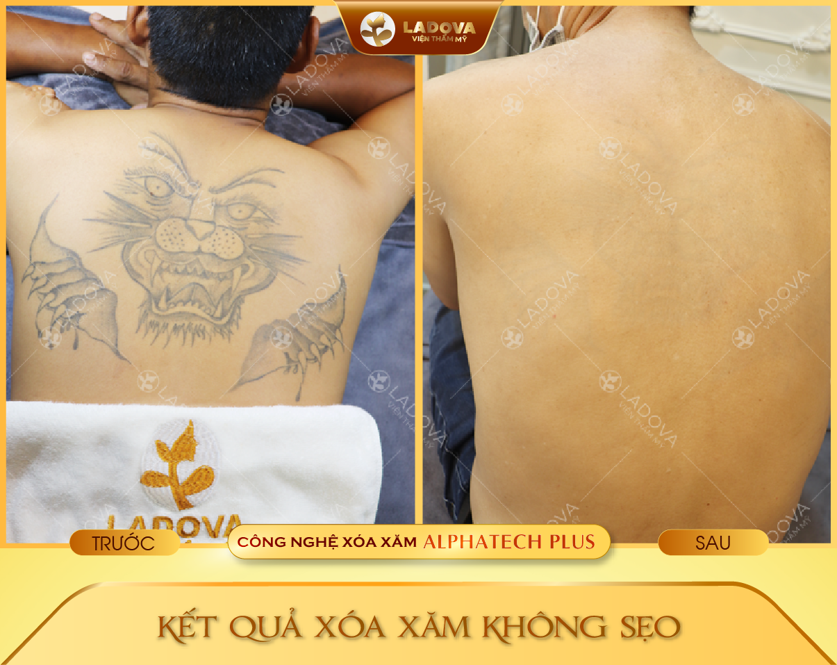 xoa-hinh-xam-o-lung-01