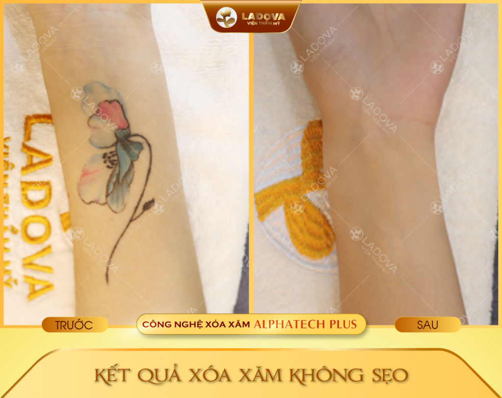 xoa-hinh-xam-o-tay-01