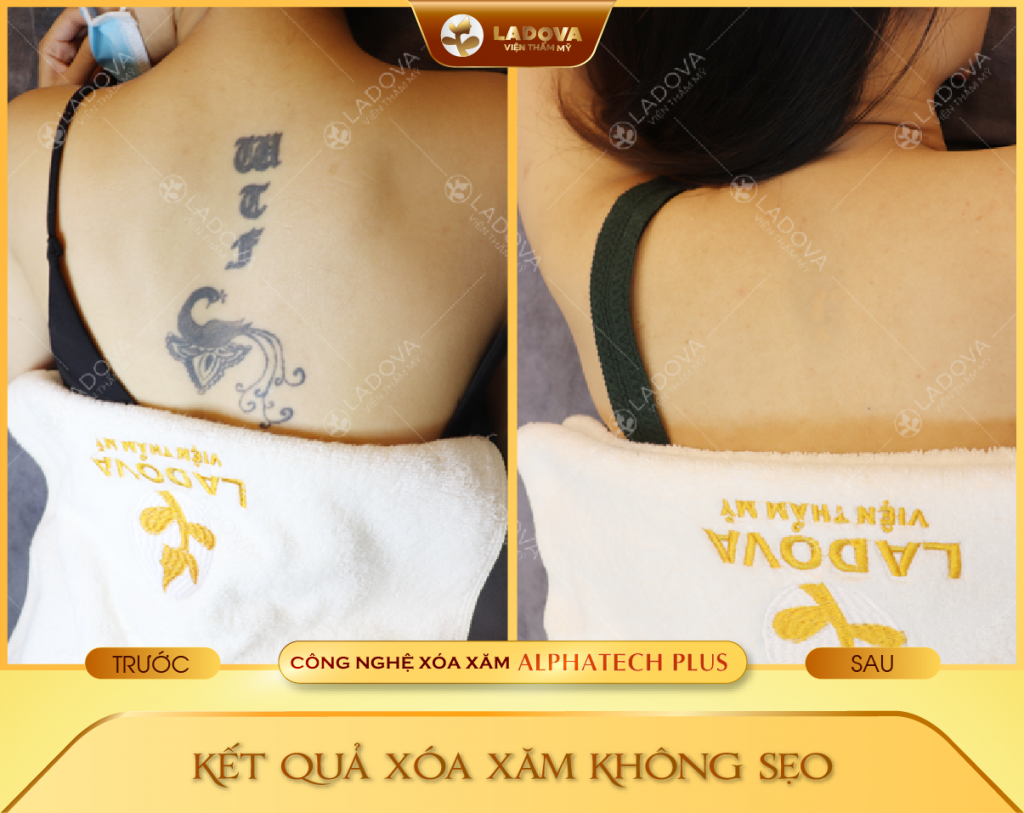 xoa-hinh-xam-tphcm-01