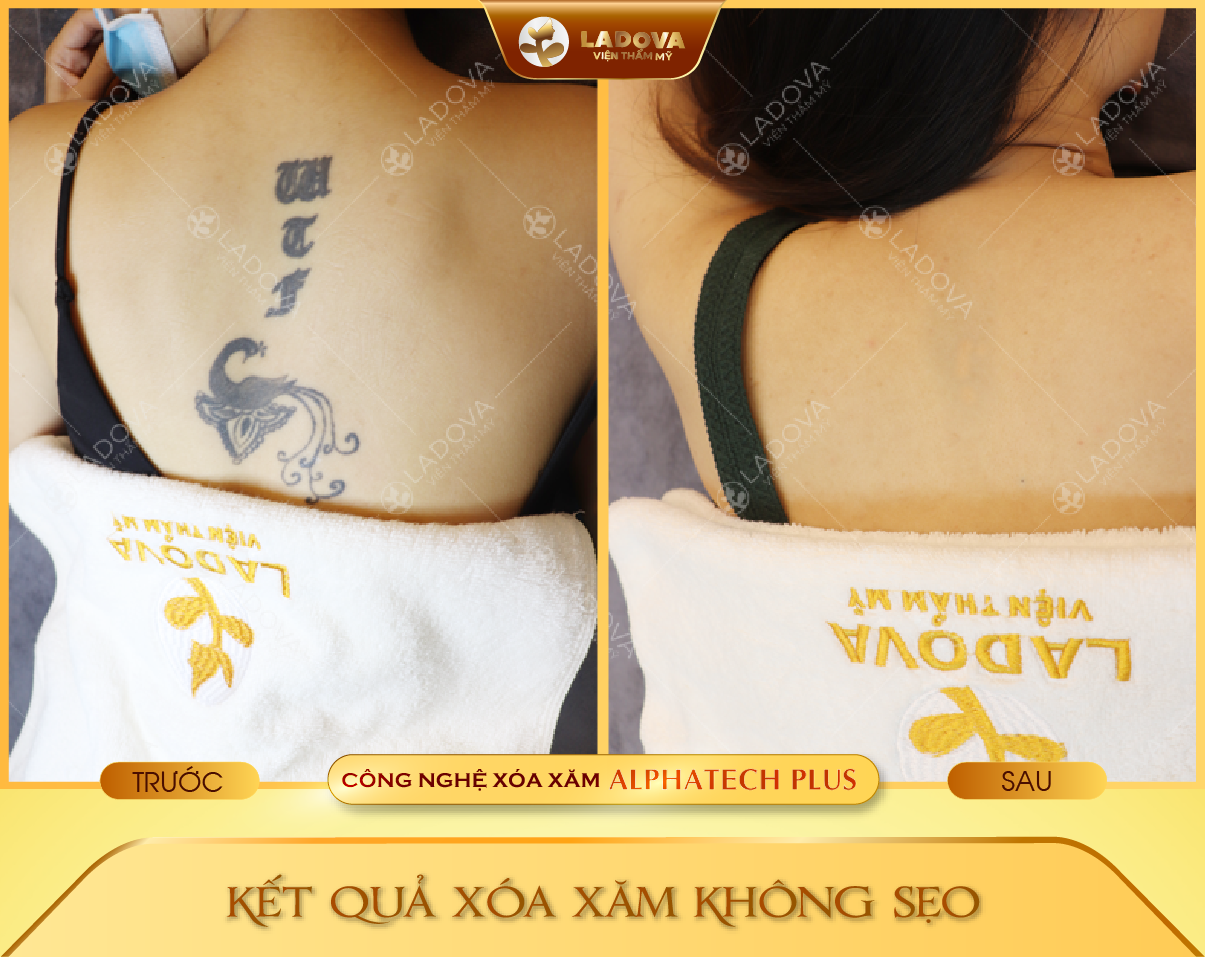 xoa-hinh-xam-tphcm-01