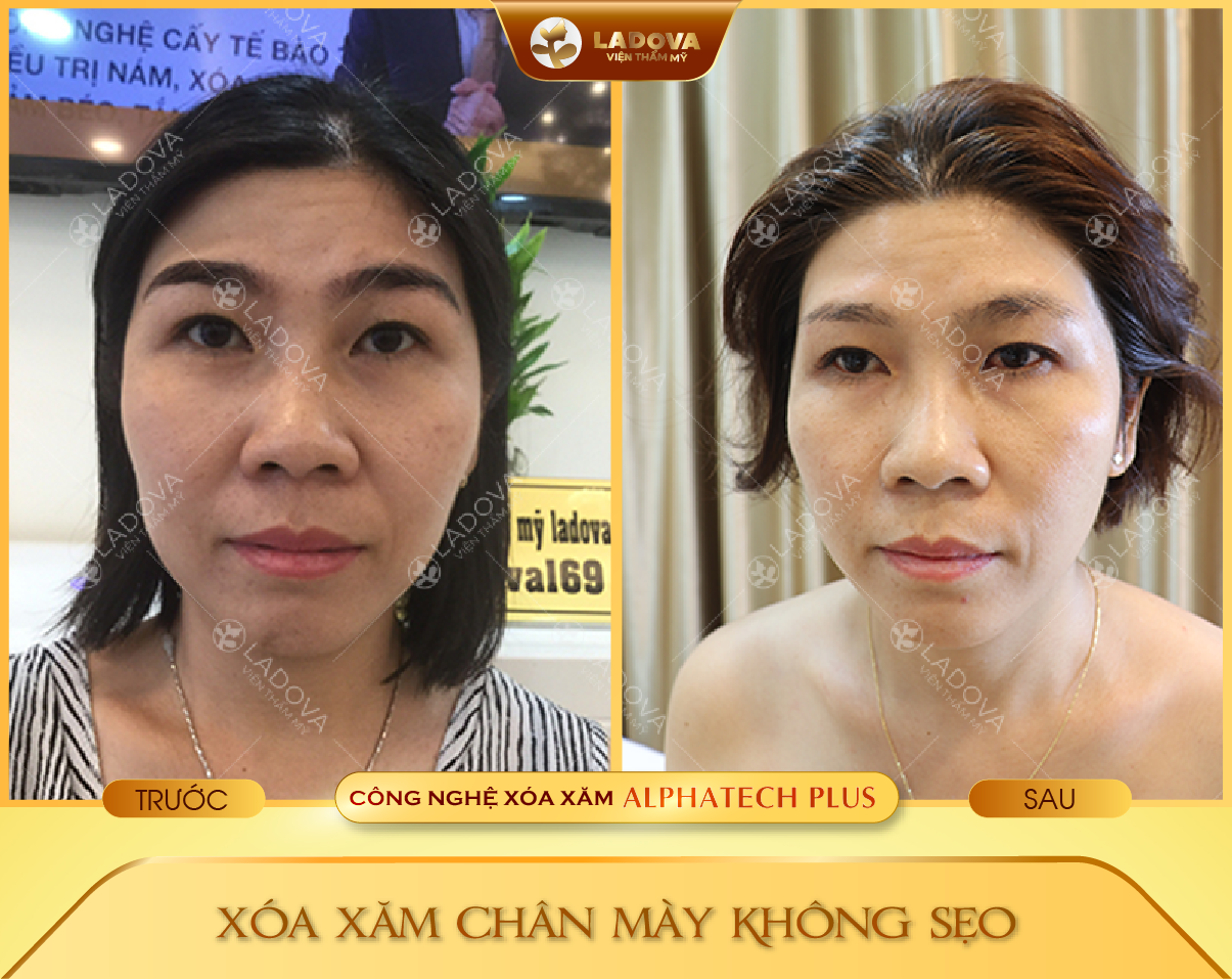 xoa-xam-long-may-bang-laze-01