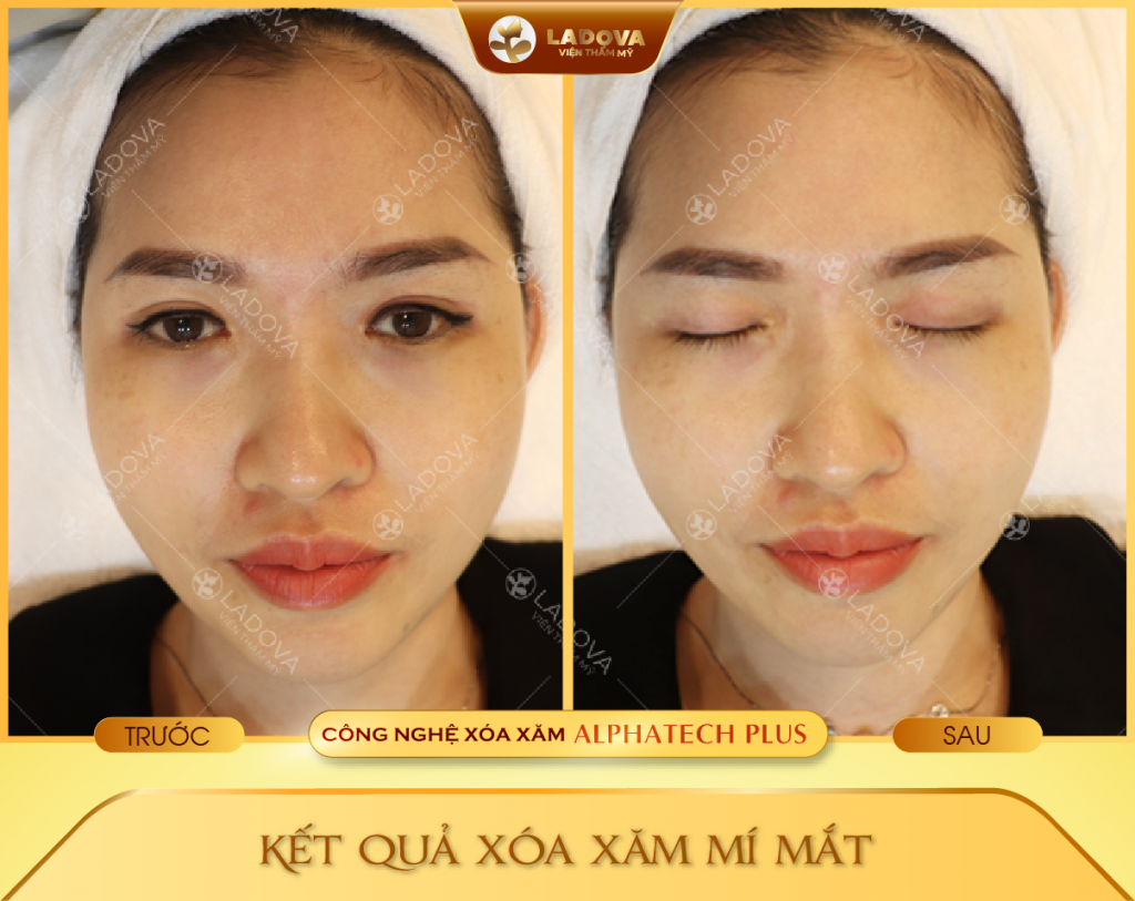 xoa-xam-mi-mat-khong-seo-01