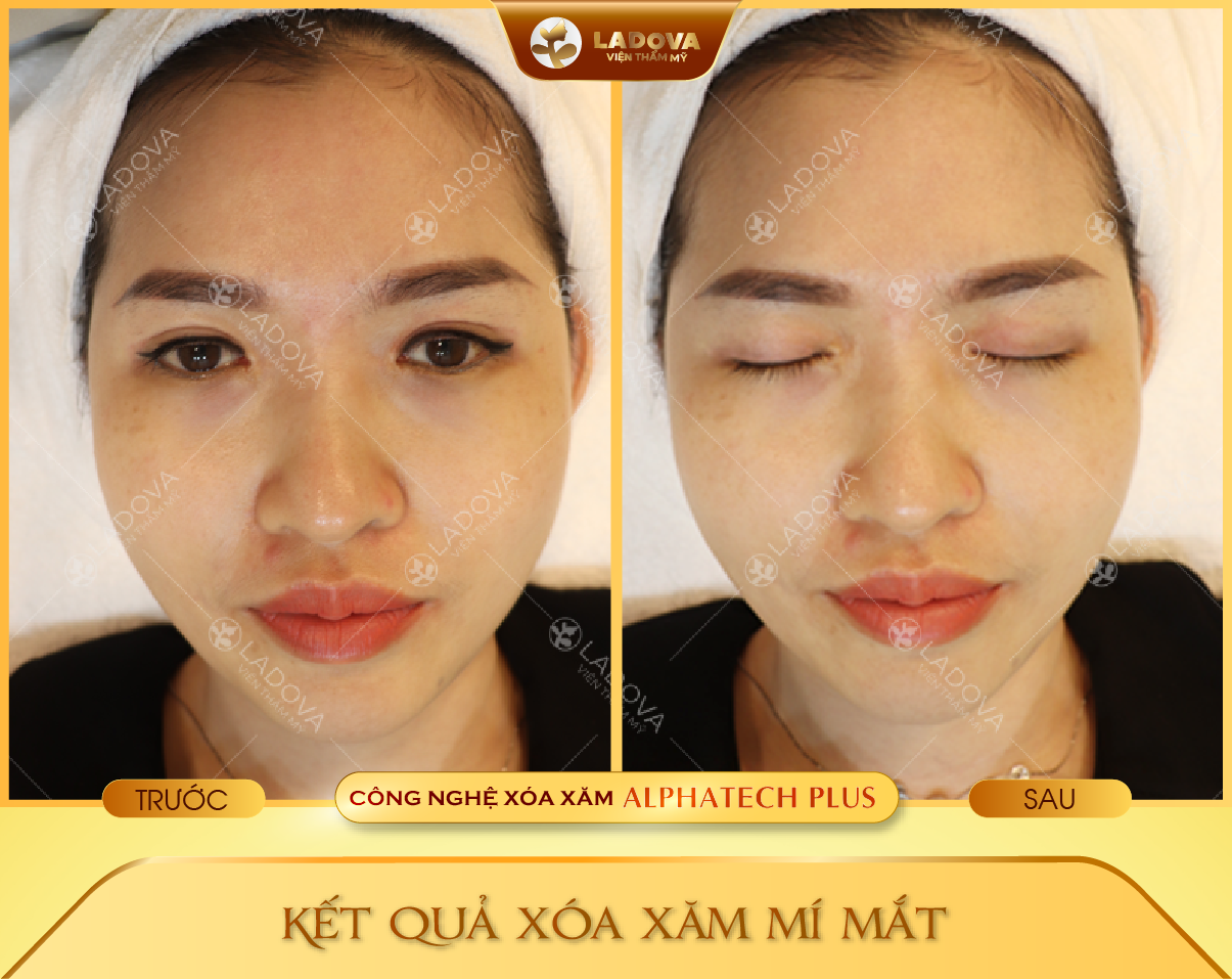 xoa-xam-mi-mat-khong-seo-01