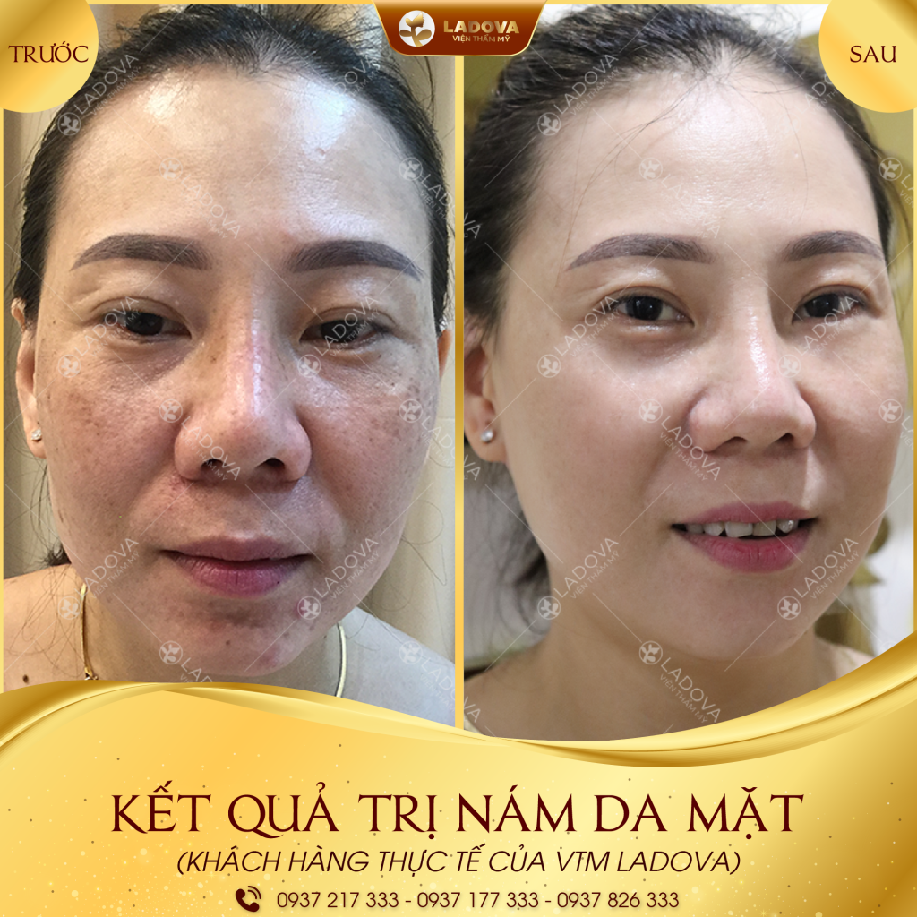 KET-QUA-TRI-NAM-DA-MAT-01