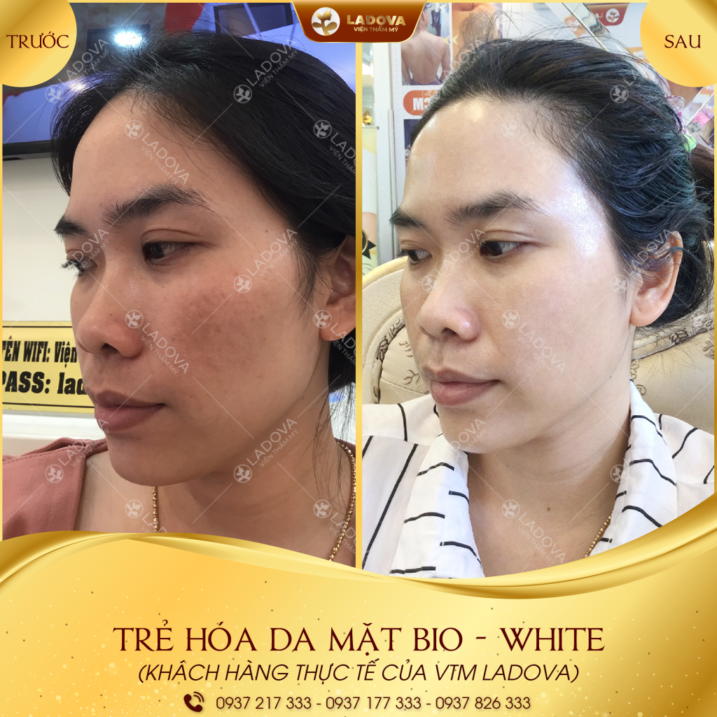 TRE-HOA-DA-MAT-BI-O-01-01
