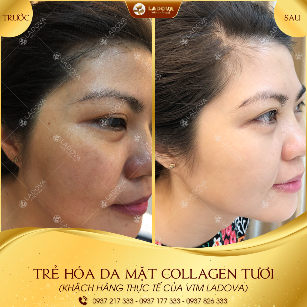 TRE-HOA-DA-MAT-COLLAGEN-TUOI-01-01