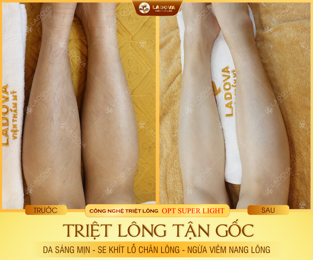 triet-long-chan-gia-re-01