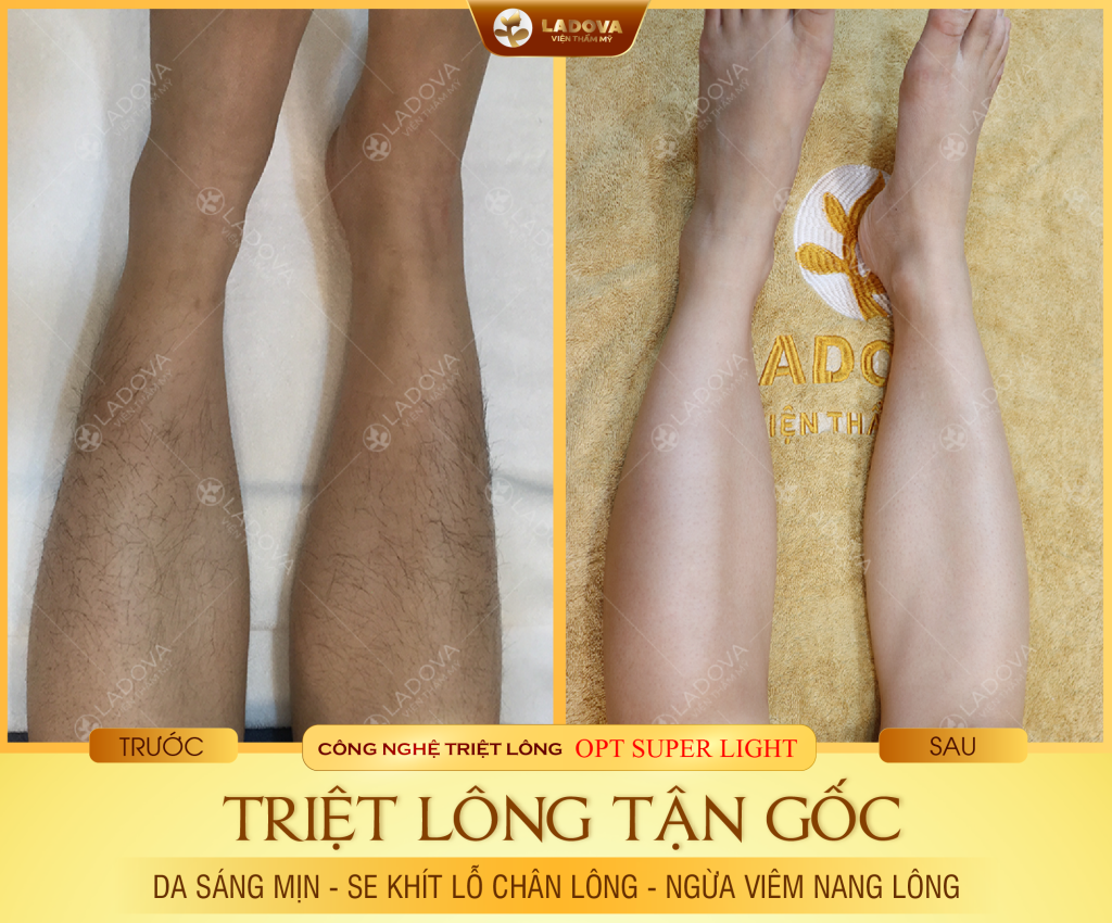 triet-long-chan-o-dau-tot-01