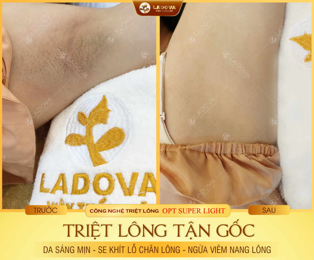 triet-long-nach-hieu-qua-nhat-01