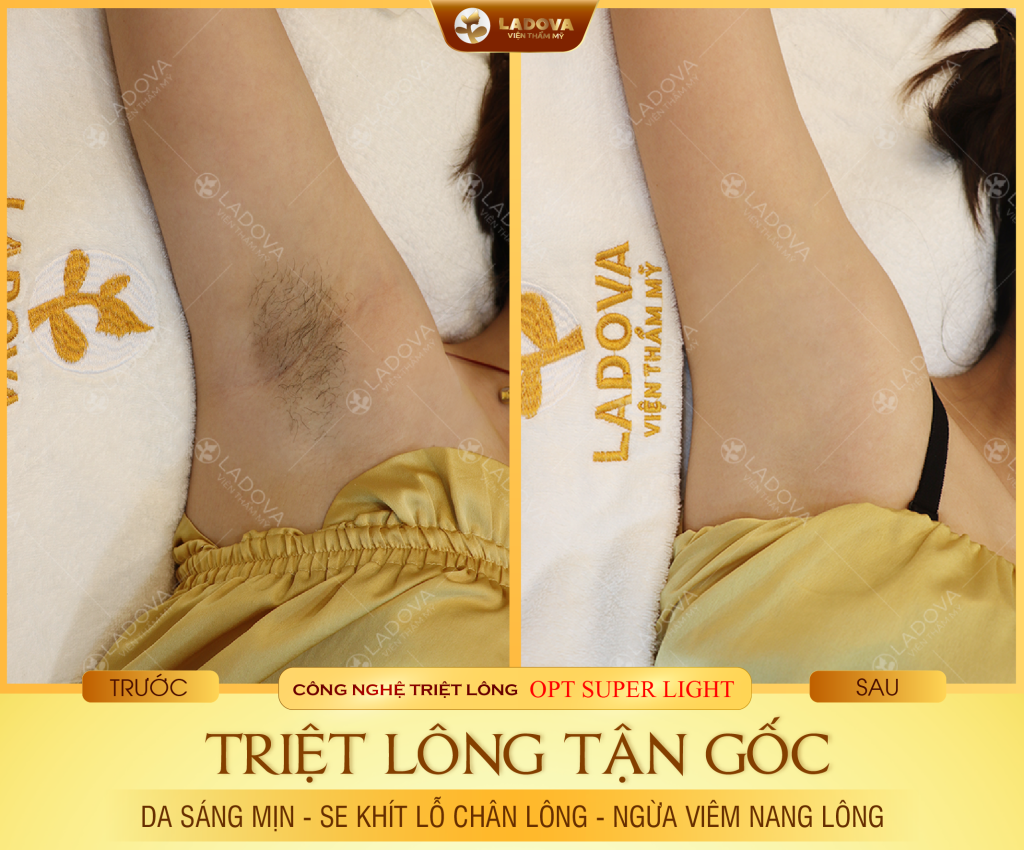 triet-long-nach-tan-goc-01