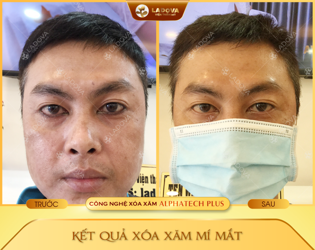 xoa-xam-mi-mat-an-toan-01