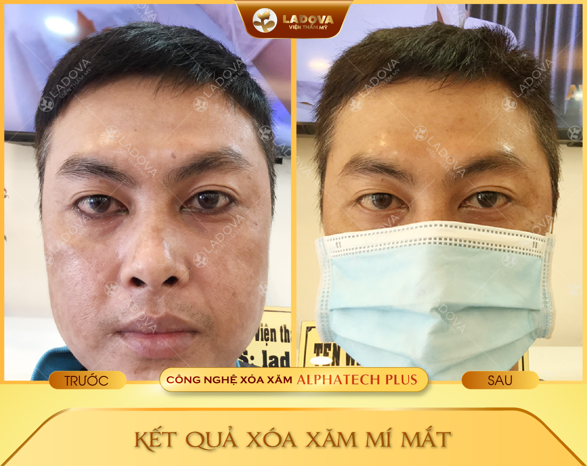 xoa-xam-mi-mat-an-toan-01