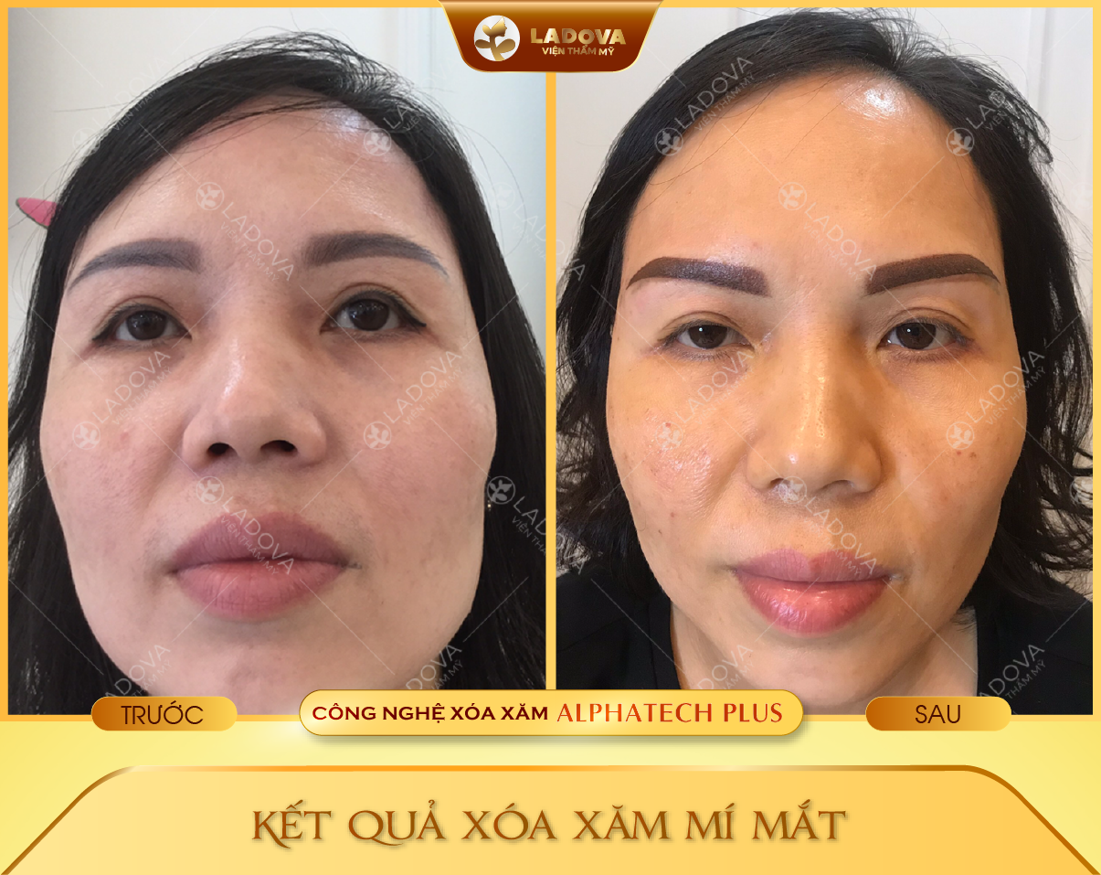 xoa-xam-mi-mat-gia-re-01