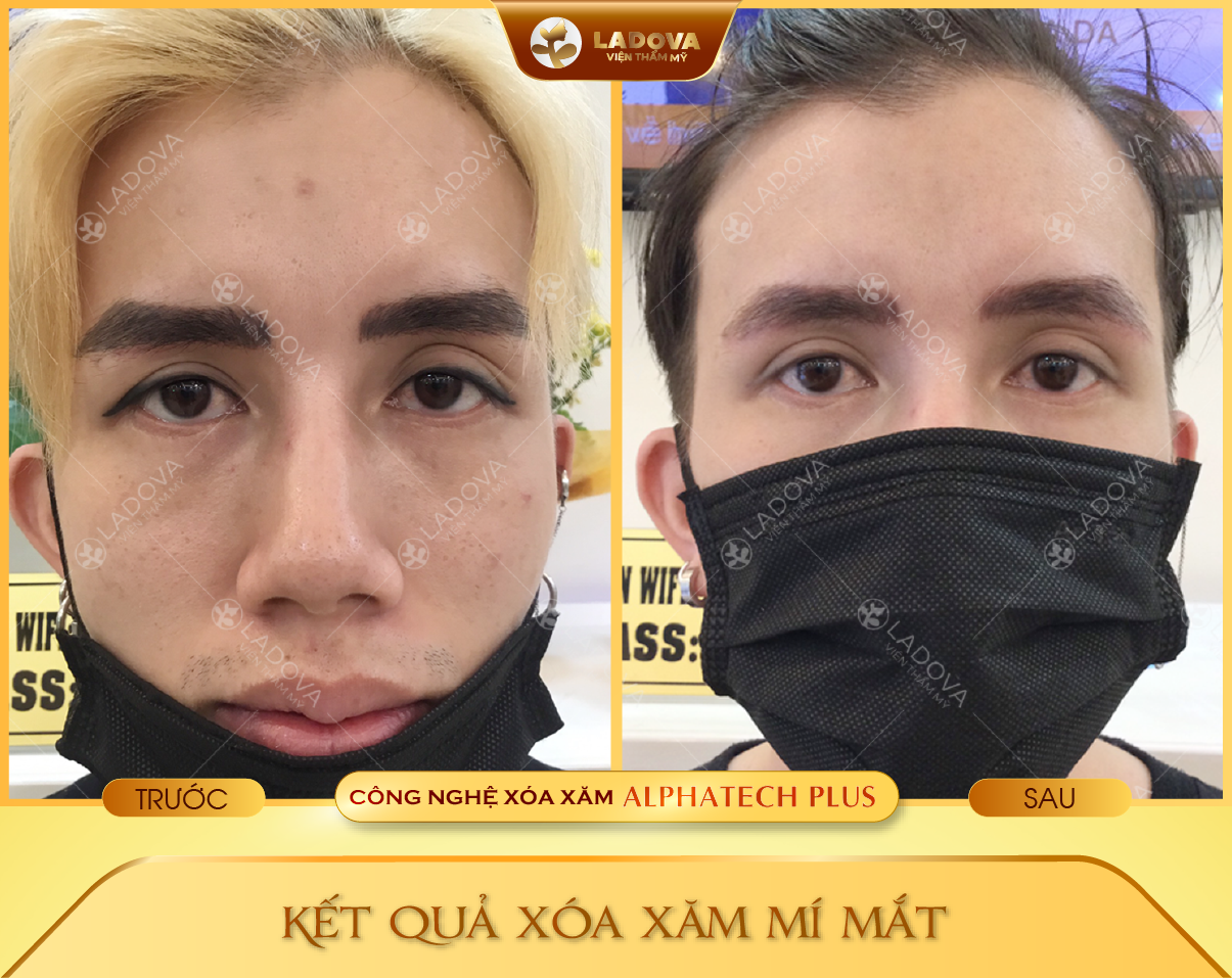 xoa-xam-mi-mat-o-dau-01