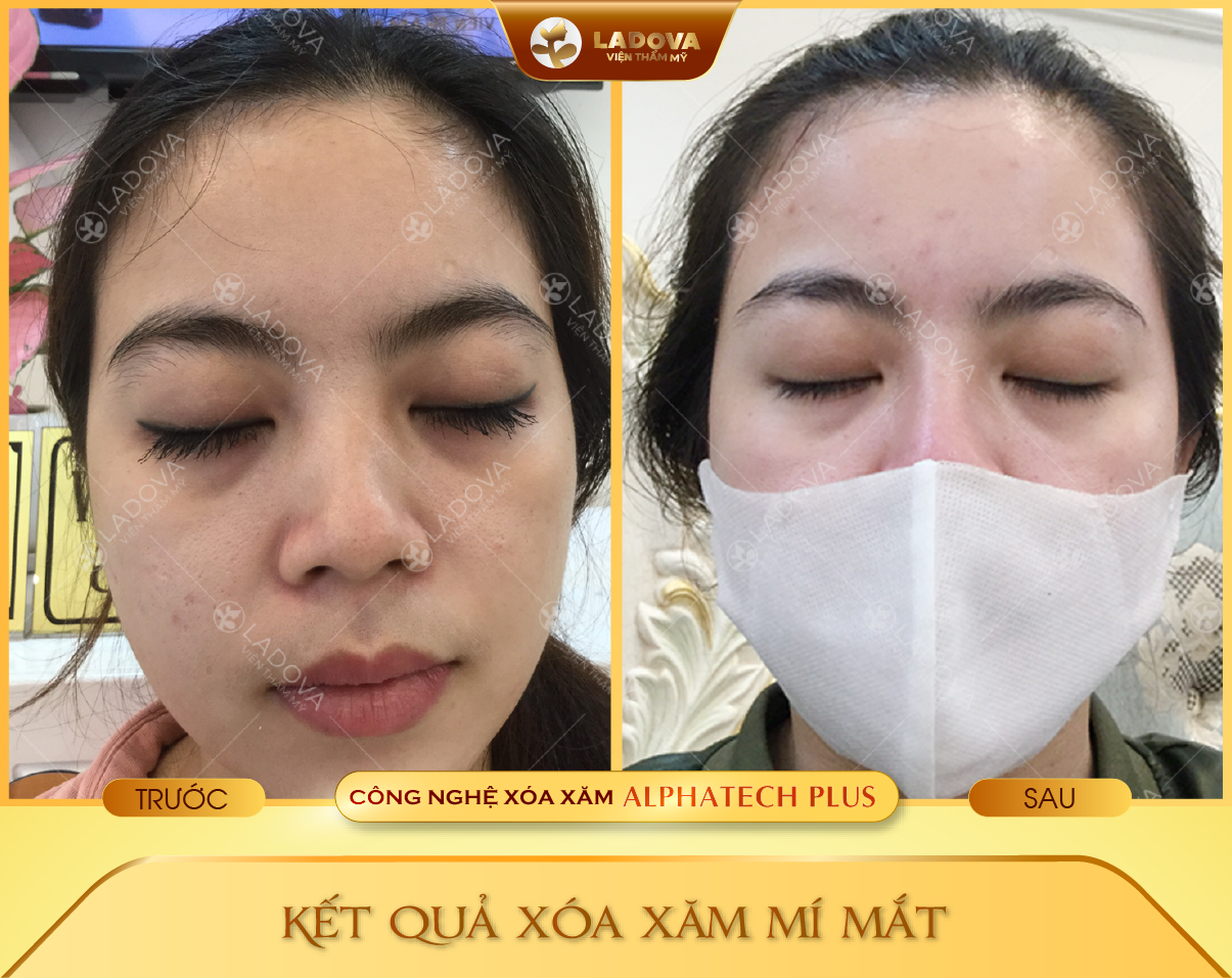 xoa-xam-mi-mat-o-tphcm-01