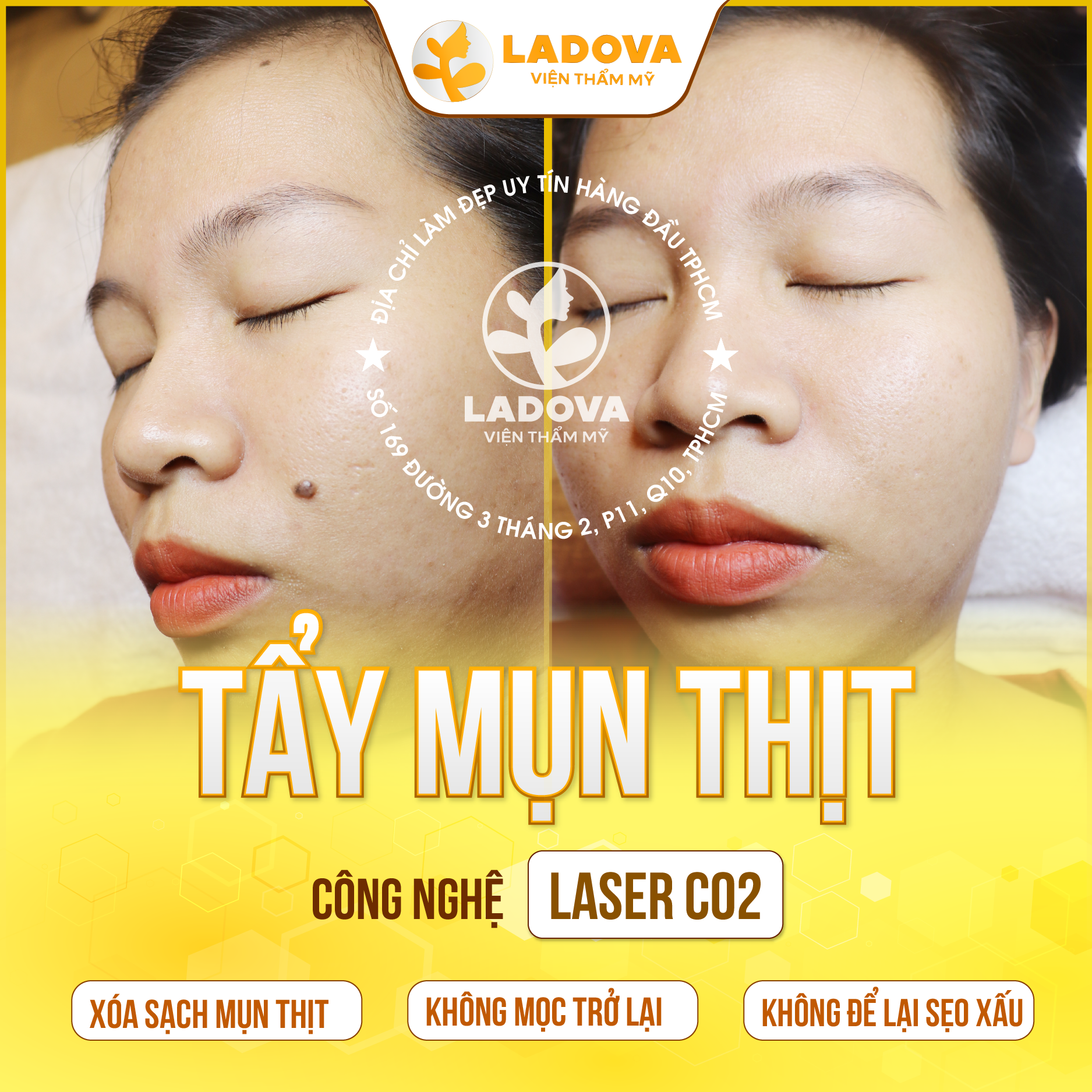 TAY-MUN-THIT-GIA-RE-NHAT-01