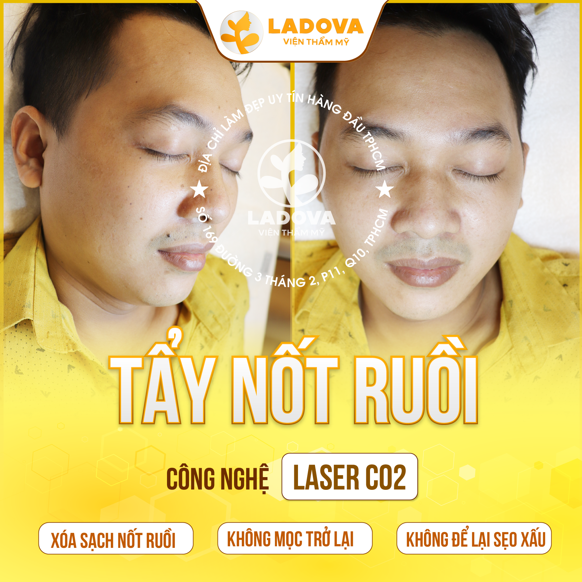 TAY-NOT-RUOI-BANG-LASER-01