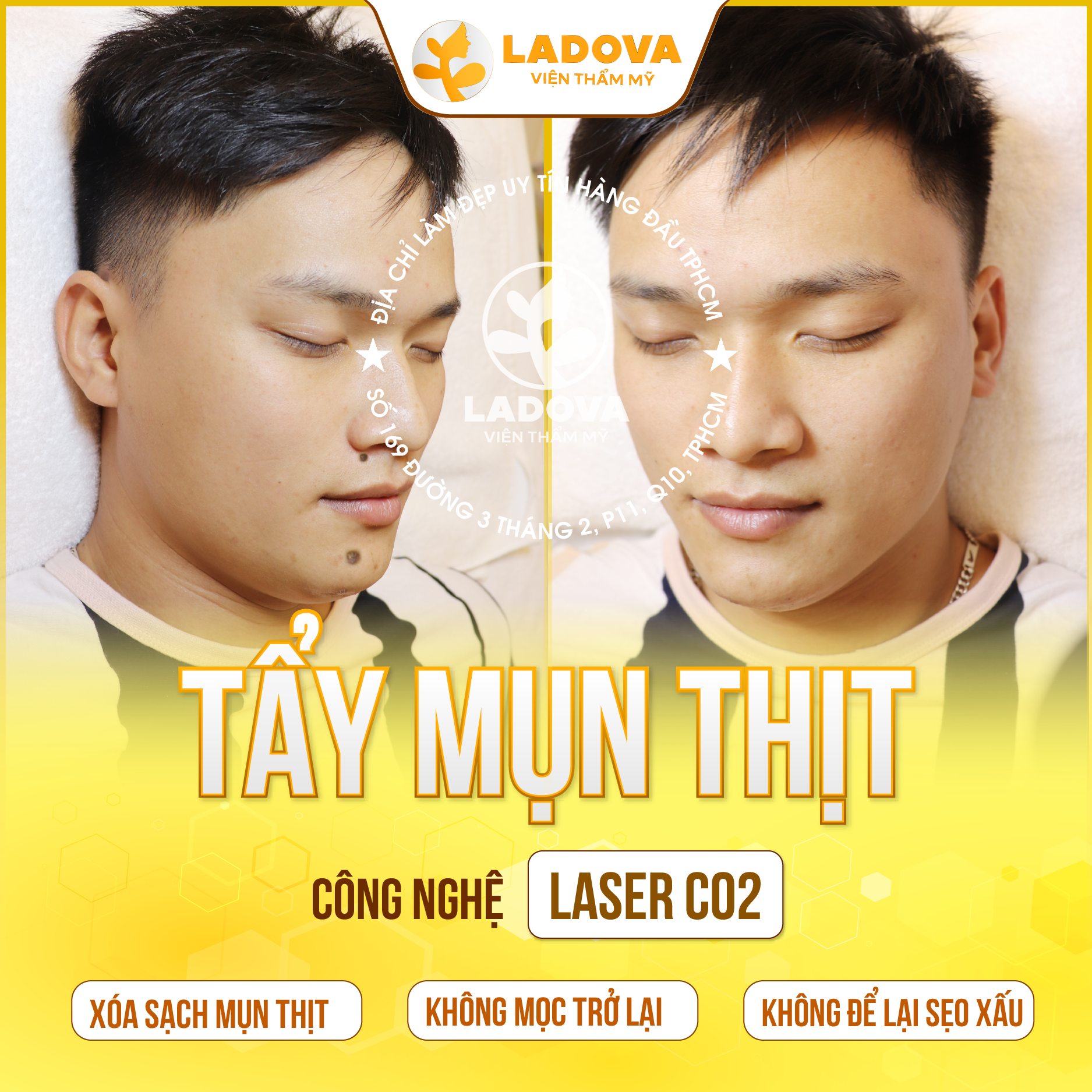XOA-MUN-THIT-TAN-GOC-01