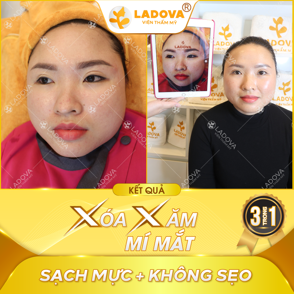 cach-xoa-xam-mi-mat-01