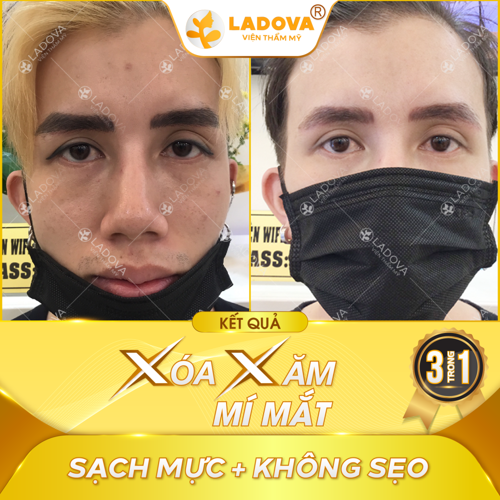 cong-nghe-xoa-xam-mi-mat-01