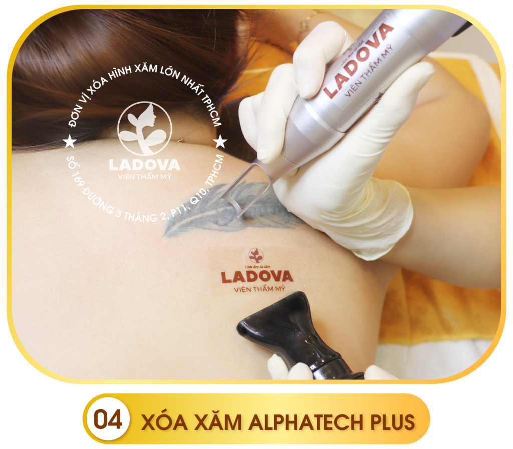 quy-trinh-xoa-hinh-xam-ladova-04
