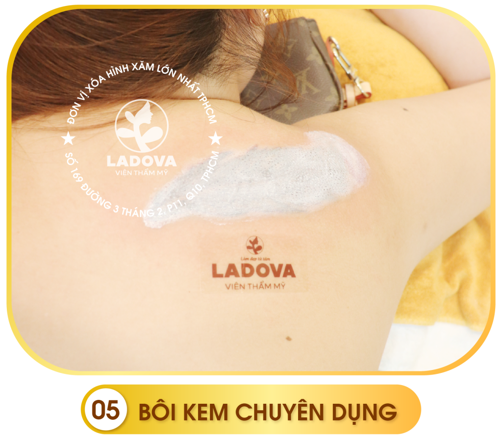 quy-trinh-xoa-hinh-xam-ladova-05