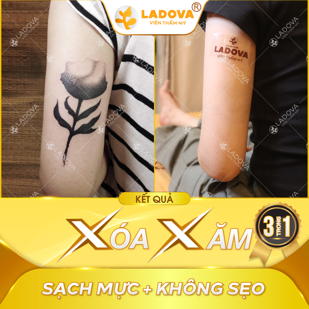 xoa-xam-hieu-qua-nhat-01